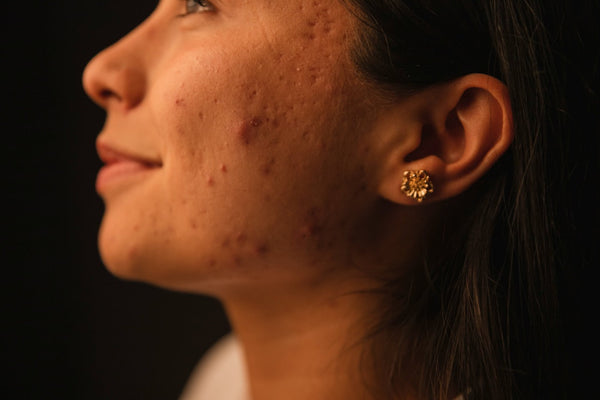 Why You Really Shouldn’t Pop Your Pimples (But What To Do If You Just Did)